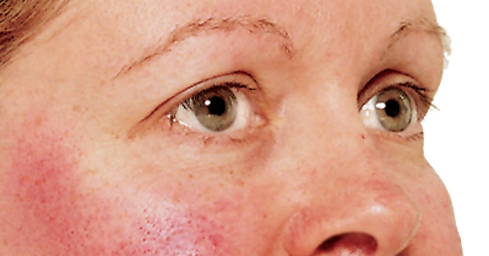 Rosacea|What is rosacea|Signs and symptoms of rosacea 