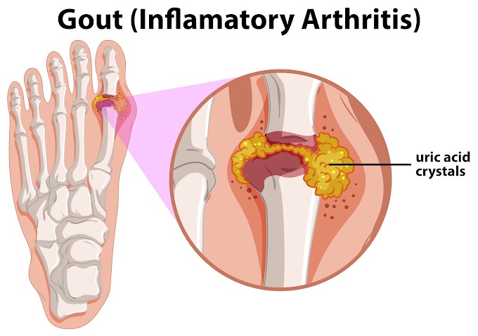 Ayurvedic Approach to Gout: Effective Home Remedies for Pain Relief