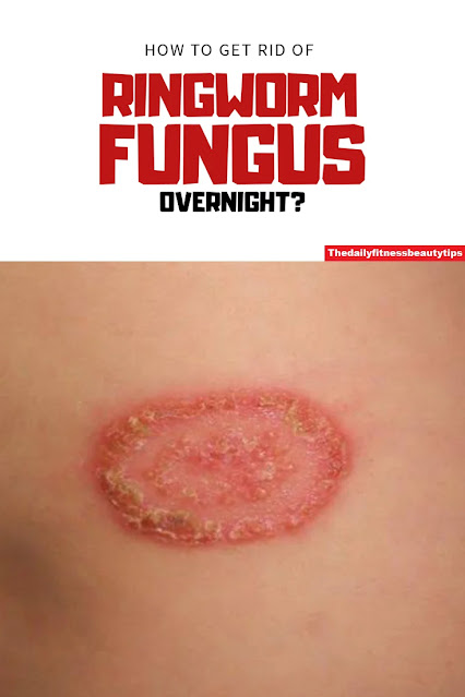 ringworm pictures