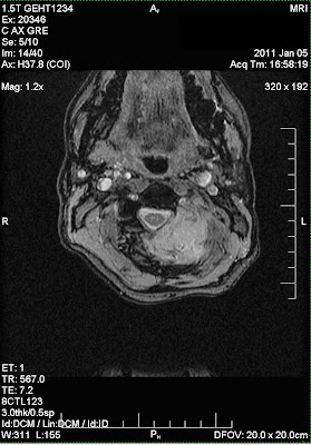 MRI image of skull and neck cervical vertebrae and sarcoma tumor