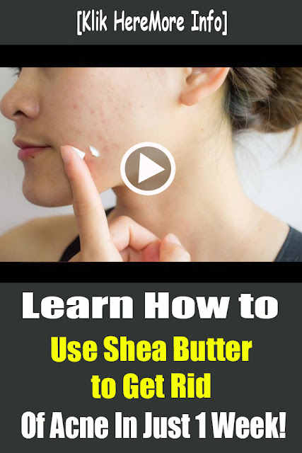 Learn How to Use Shea Butter to Get Rid of Acne