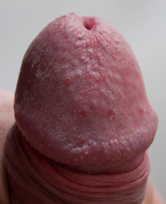 Yeast infection on penis - Red rash