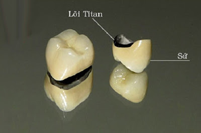 Đặc điểm răng sứ kim loại bạn nên tham khảo 2