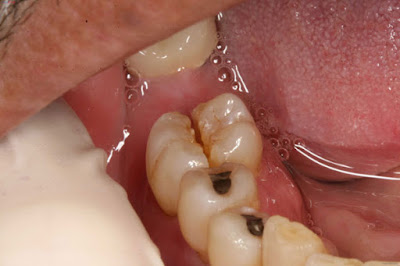 Thông tin nhổ răng hàm bao nhiêu tiền nha khoa chia sẻ-2
