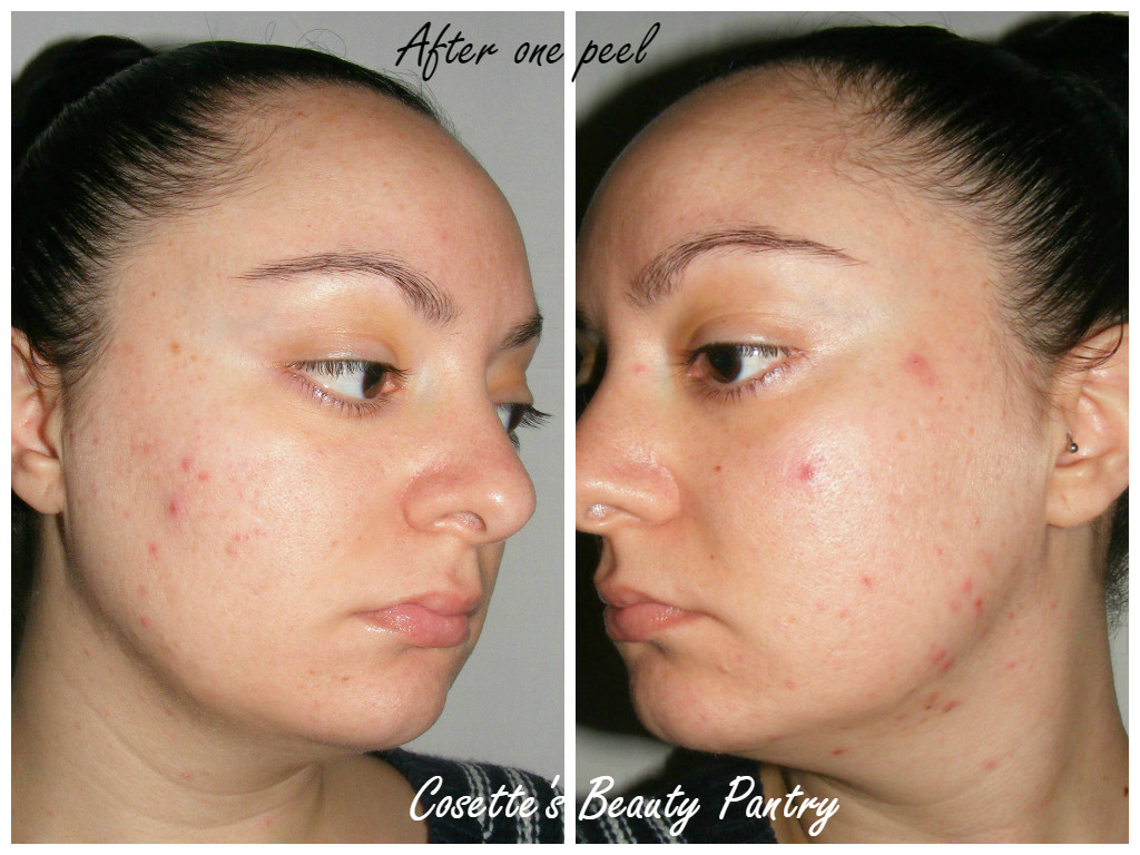 Fruit Acid 15% Gel Peel Review ~ Cosette's Beauty Pantry