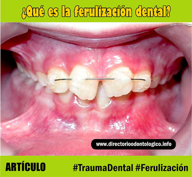 ferulización-dental