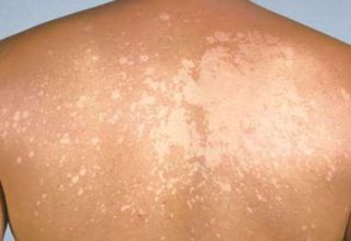 Le Pityriasis versicolor est une mycose superficielle, liée à la prolifération sur la peau d'un champignon commensal : Malassezia furfur. Ce champignon affectionne particulièrement les peaux grasses, siégeant sur le thorax mais également sur le cou et les épaules, sur les membres supérieurs, et rarement sur les membres inférieurs.