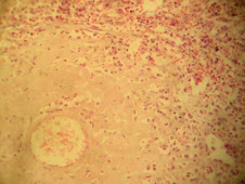 Amiloidosis en bazo