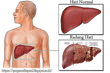 MASALAH RADANG HATI | Aafiyat Lifestyle