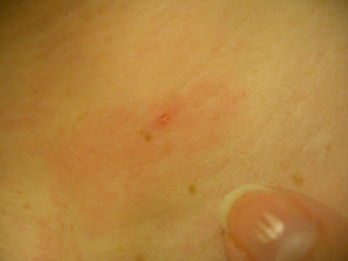 Bed bug bites photos