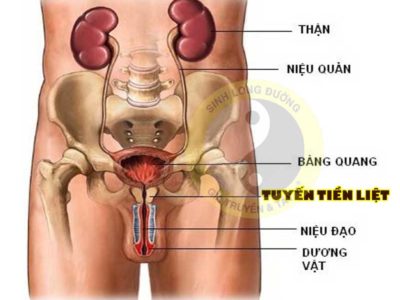 Viêm tuyến tiền liệt được hiểu là bệnh gì?