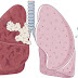 Asbestos Lung Cancer Remedy and Mesothelioma Facts