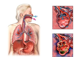 Nursing Diagnosis for Pneumonia