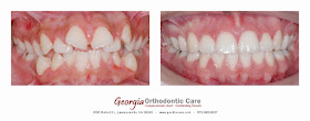 Teeth Extraction for Orthodontic Treatments, Lawrenceville Orthodontic, GA 30043