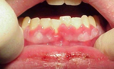 Lưu ý khí sử dụng thuốc viêm nướu răng