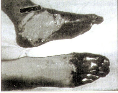 Figure 3-Trench Foot.An advanced grade.