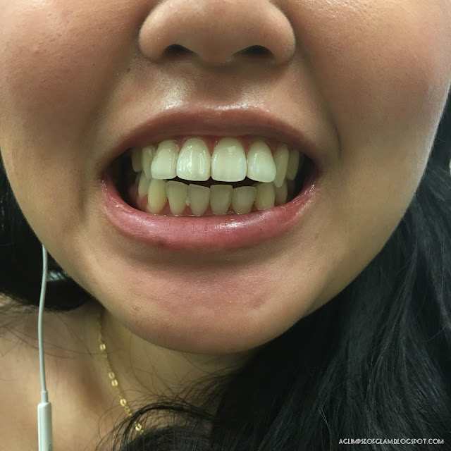 Before Photo for Smile Brilliant Teeth Whitening Review - Andrea Tiffany A Glimpse of Glam