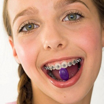 Niềng răng là cách chữa răng cửa to và hô an toàn và triệt để nhất