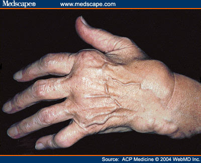 Because there are over types of arthritis, symptoms of 