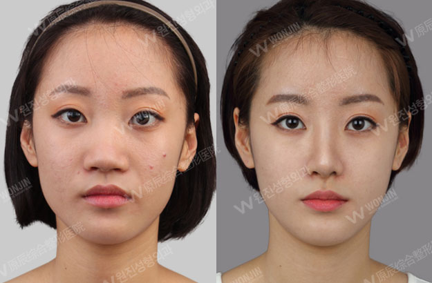 짱이뻐! - [Before and After Photos] Korean Rhinoplasty