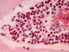Manguitos eosinofílicos (ClNa)