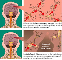 alzheimer