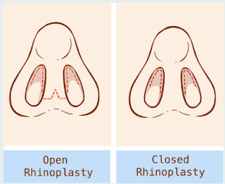 open rhinoplasty surgery, closed rhinoplasty