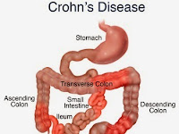 Penyebab dan Gejala Penyakit Crohn