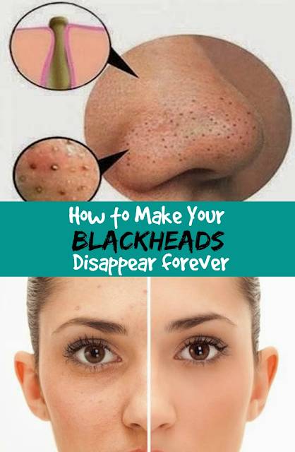 How to Make Your Blackheads Disappear forever