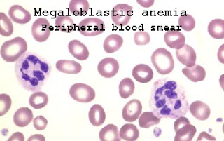 case study megaloblastic anemia