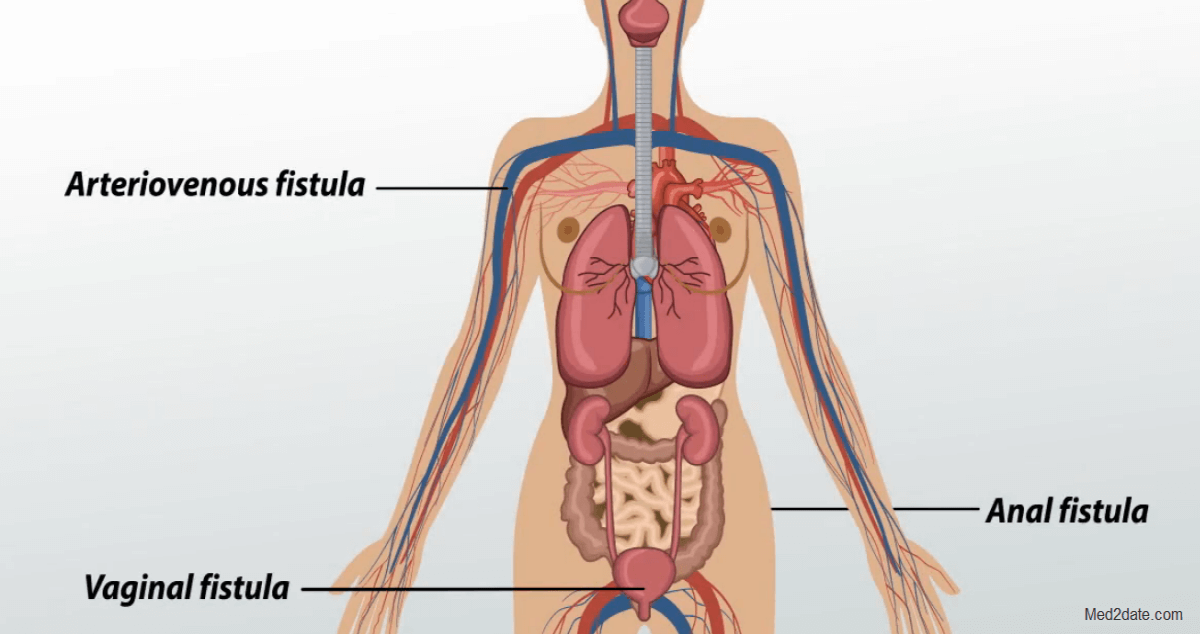 Sinus-fistulae