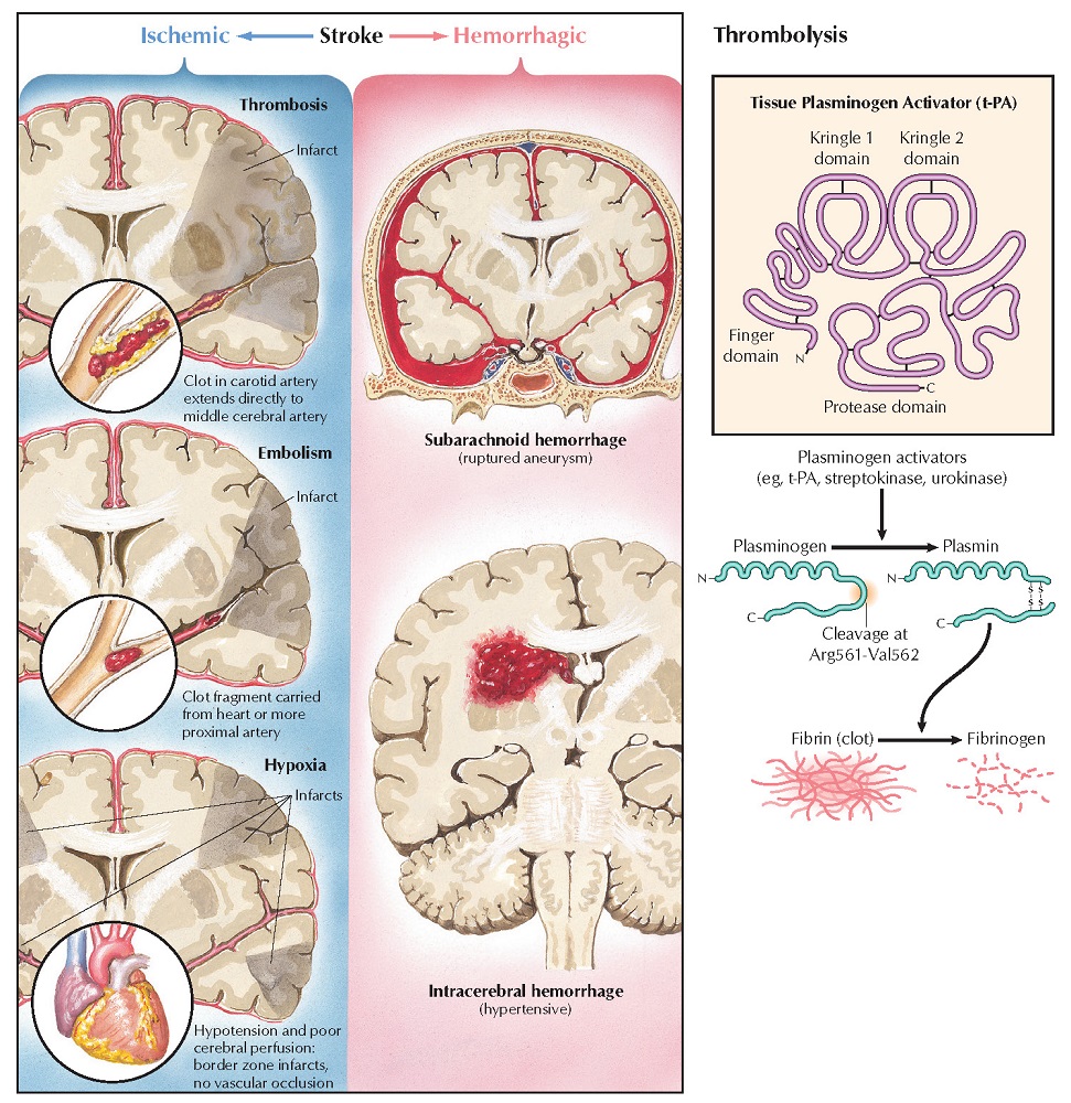 Stroke: Symptoms and Drug Treatment