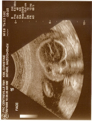 sonogram 5 weeks. sonogram 5 weeks.