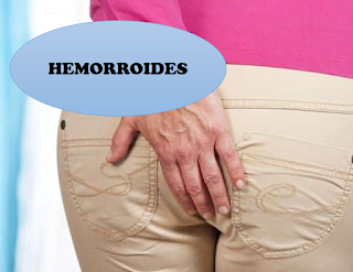 https://natwiki.blogspot.com/2018/07/hemorroides-remedios-caseros-y-cambios.html