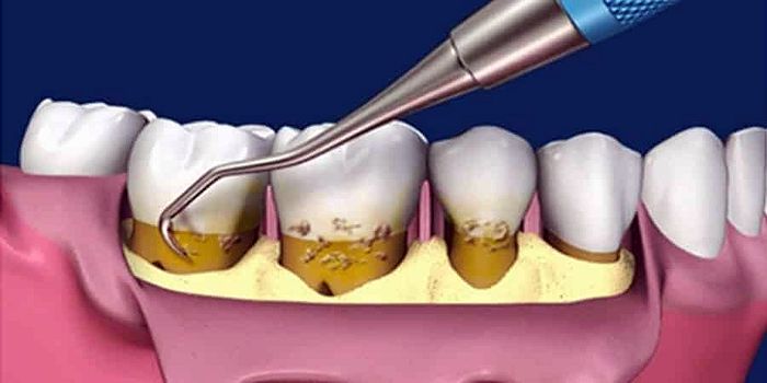 Periodoncia