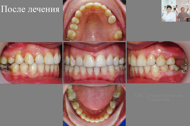 Зубы ПОСЛЕ ортодонтического лечения. Нестандартные аппараты