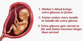 What Causes Gestational Diabetes