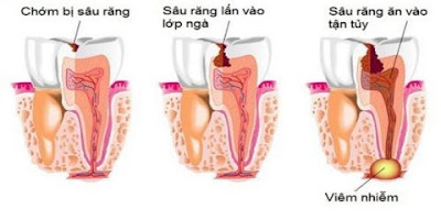 Cảnh báo răng sâu ăn vào tuỷ gây nguy hại-1