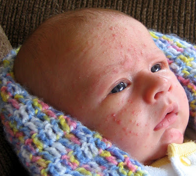 baby acne