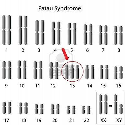 Cariótipo da síndrome de Patau