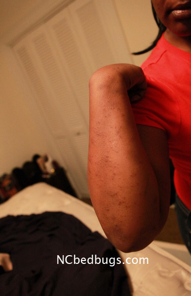 Bed Bug Bites On African American Skin Bed bug bites (a photo taken