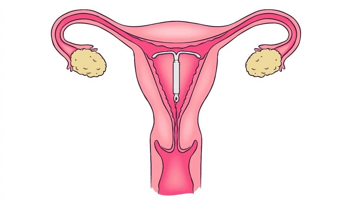 IUD Insertion