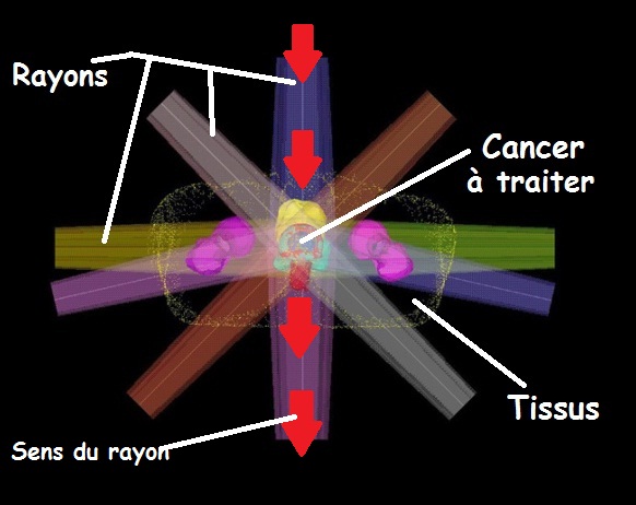 tumeur cerveau dernier stade