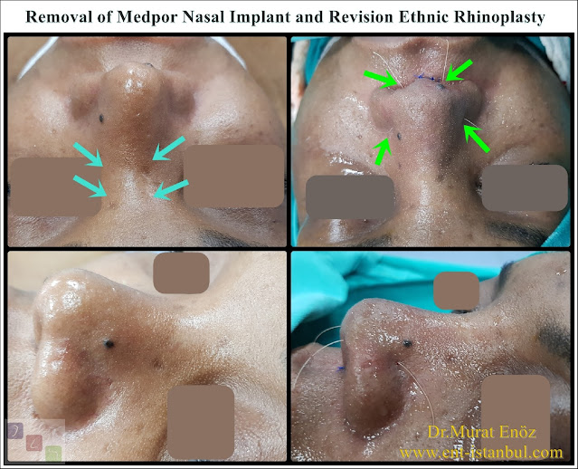 Revision Ethnic Nose Surgery in Istanbul,Ethnic expert rhinoplasty surgeon,Medpor Implant Removal, Revision African American Rhinoplasty