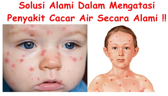  Obat Tradisional Tuntaskan Cacar Air