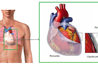 Pericarditis aguda