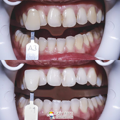 Laser Teeth Whitening Before and After Photo - A3 Tone to A1 Tone