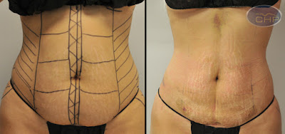 before and after picture of liposuction