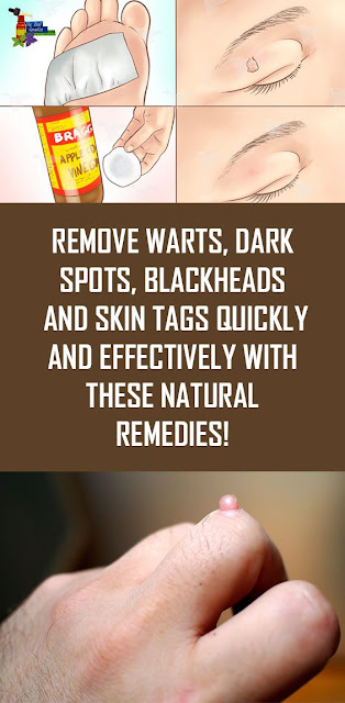 Natural Remedies To Remove Warts, Dark Spots, Blackheads And Skin Tags Quickly