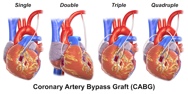 coronary artery bypass surgery, coronary artery bypass graft (cabg) surgery, heart bypass surgery in india, surgery coronary artery bypass graft, heart bypass surgery cost in india, cabg cost in india, bypass surgery cost in india, open heart surgery cost in india, minimally invasive heart surgery, 